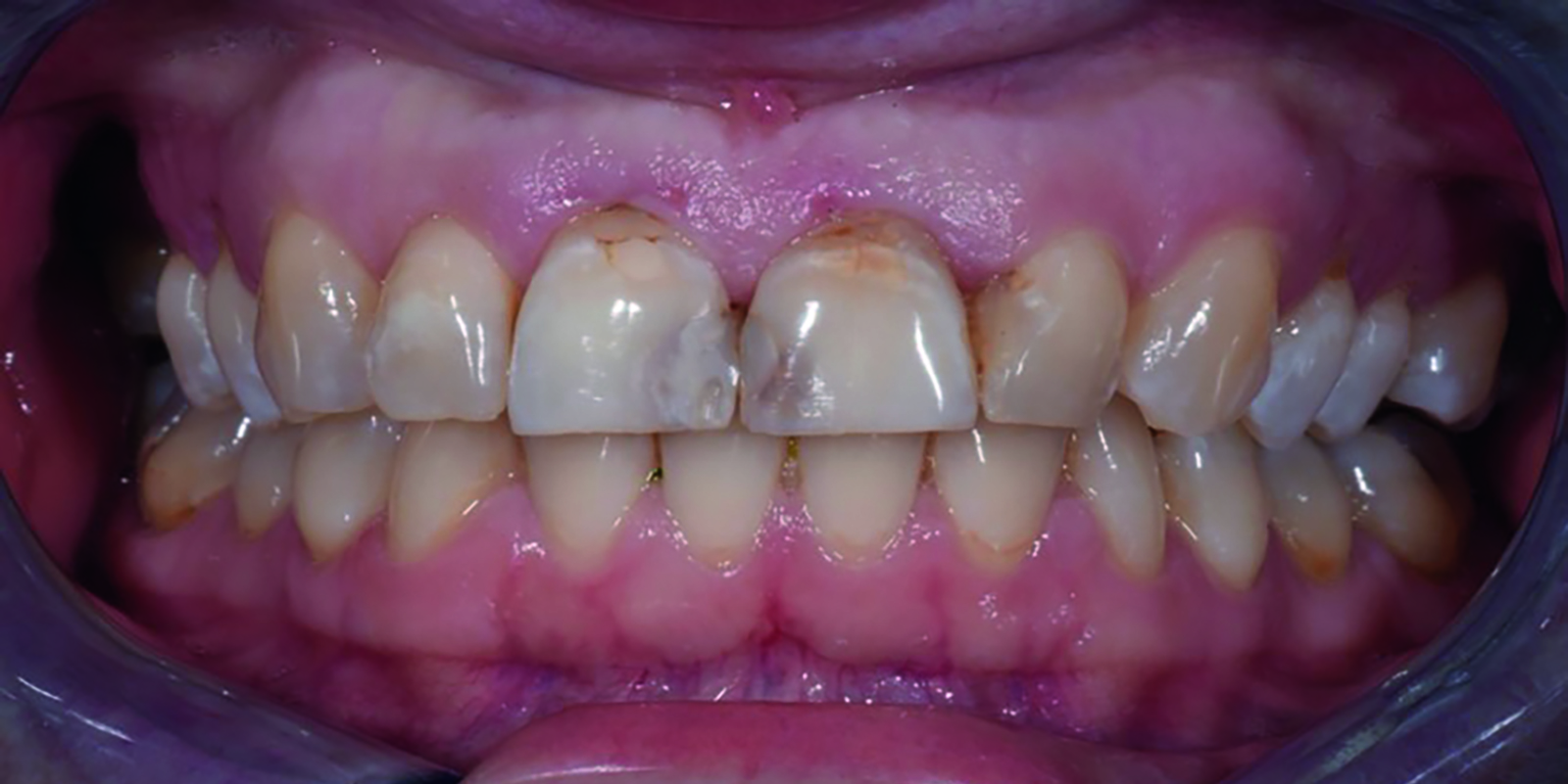 Case report Figur 1 bleking med Opalescence